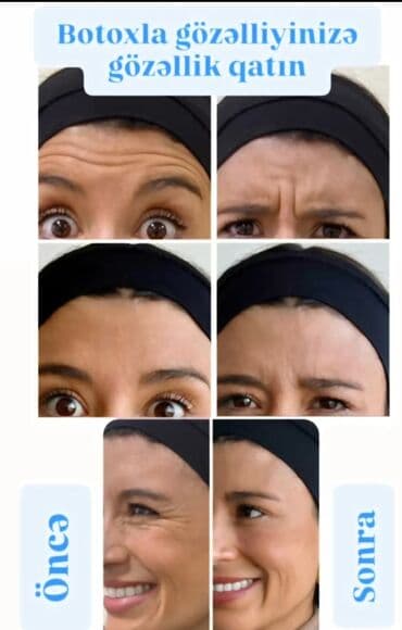 Botox 70azn Qirislara vaxtinda mudaxile edin.Botoxla zamanı dayandirin