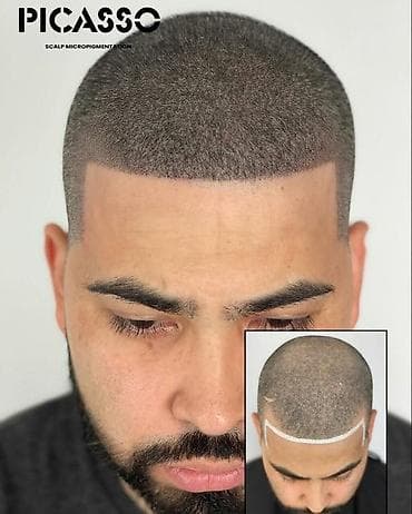 xidmət: Tatto nökte atişiylariyla tük effekti yaradib keçelliyi örten — 2
