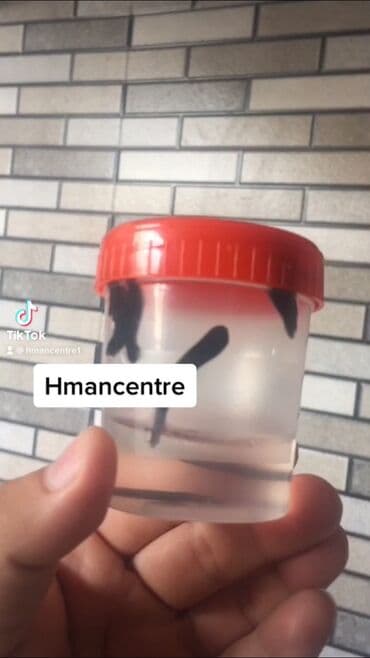 sari tukler ucun lazer: Bəylər üçün = Hicama Və Zəli ✅Zəlinin Faydaları(Hirudoterapiya) — 13