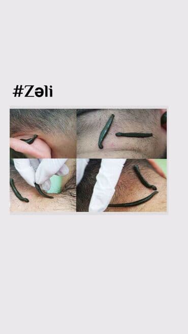 ağ dırnaq modelleri: Hicamanın Faydaları✅ *Qan dövranın pozulması *Qanın təmizlənməsi — 10