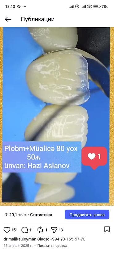 avtomobil yuma: İndi Daha Rahat və Estetik 💠 Qiymətlər Estetik plomb (1 diş) – 50₼ — 3