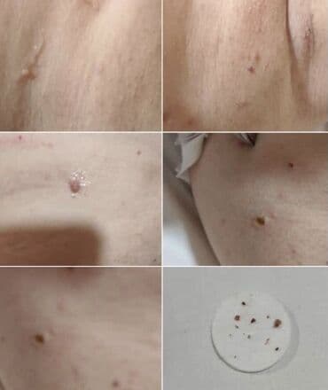 Медсестры: Xidmət: Hicama, zəli terapiyası və dəri törəmələrinin (balaca — 3