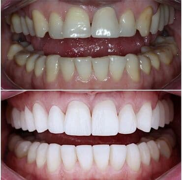 акция на установку брекетов: Stomatoloji xidmetler tam steril ve muasir. dislerin plomblanmasi — 7