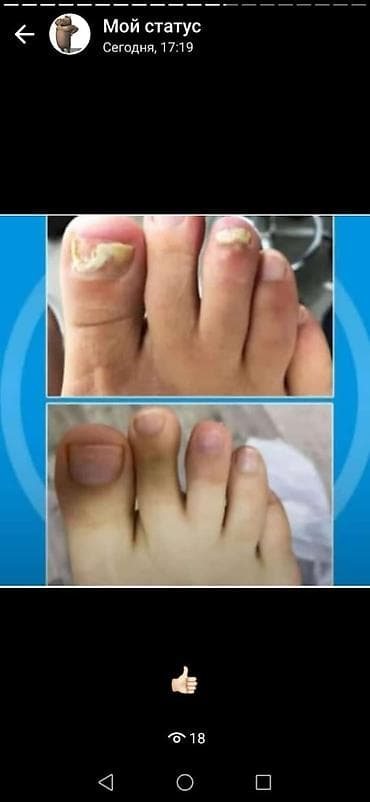 gumus sepler: Deri xestelikleri.sac tokulmesi.kecellesme.kepek.ayaqda qribok.iy — 5