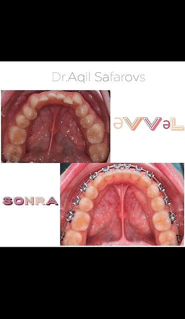 Ремонт техники: Ortodontik müalicə və gülüşün tam bərpası xidməti Təsvir: - Dişlərin — 2