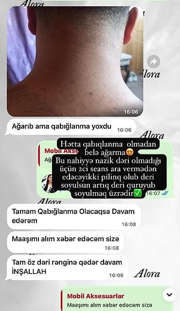 ten effekti permanent: Boyun və kürək nahiyəsində qaralmanın açılması üçün peşəkar pilinq — 1