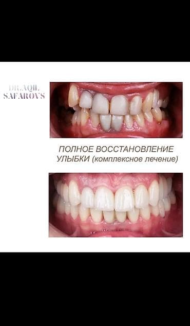 Ремонт техники: Ortodontik müalicə və gülüşün tam bərpası xidməti Təsvir: - Dişlərin — 4