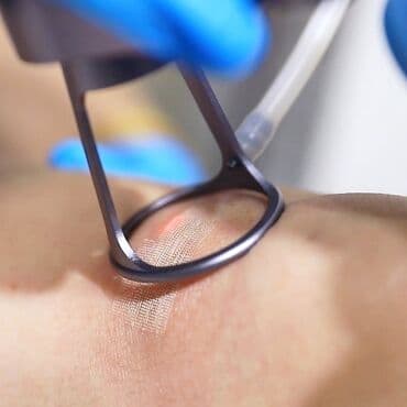 estetik: 10600 lazer cilalanması vasitəsilə müxtəlif kosmetoloji və estetik — 4