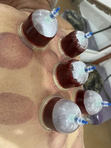 Красота и здоровье: Hirudoterapiya və Hicama (Qan çıxarma) xidməti - Hirudoterapiya — 4