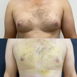 dermapen qiymeti: Plastik estetik hər yüksək səviyyə uyğun qiymət!!!Burdan mesaj — 12