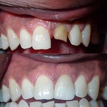 акция на установку брекетов: Stomatoloji xidmetler tam steril ve muasir. dislerin plomblanmasi — 22