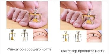 bmw 3 серия 324td mt: Для педикюрафиксатор для безболезненного удаления вросшего ногтя — 3
