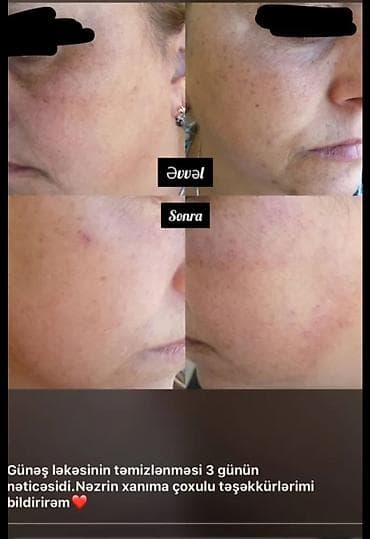 gen: GÜNƏŞ ÇİLİ VƏ LƏKƏLƏR ÜÇÜN LOSYON + SPF SETİ ☀️ Günəş ləkələri, çillər — 4