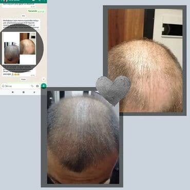 wow sac serumu: Dermanew hair saç çixaran gücləndirici Serum ilə tanış olun, köhnə — 2