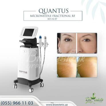 hifu smas lifting: Üz və boyun dərisinin liftinqi və dartınması üçün nəzərdə tutulan — 1