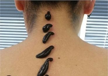 Обучение, курсы: Xidmət: Hacamat və sülük terapiyası Təsvir: - Bədəndə seçilmiş — 3