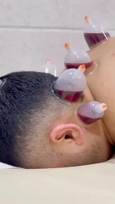 zeli: Xicama (qanın vakuumla çıxarılması) xidməti - Klassik və nöqtəvi — 2