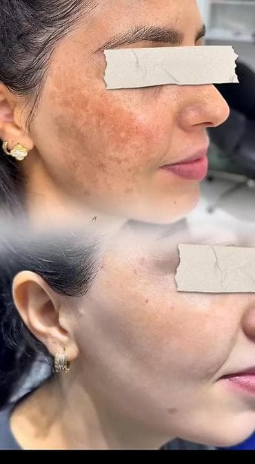 don sekilleri: Bu kremler netice superdi butun sekiller heqiqidi ve kasmetoloq — 1