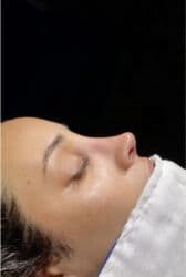 dermapen qiymeti: Plastik estetik hər yüksək səviyyə uyğun qiymət!!!Burdan mesaj — 3