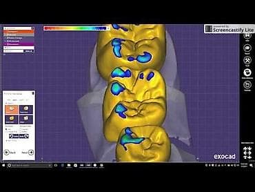 İstehsal avadanlığı: EXOCAD 3.3 9512 – diş texnologiyaları üçün CAD proqramı - Dişlərin — 3