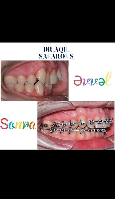 Ремонт техники: Ortodontik müalicə və gülüşün tam bərpası xidməti Təsvir: - Dişlərin — 1