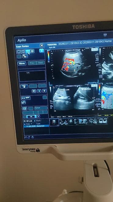 Toshiba Aplio 500 crystal seri ultrasəs aparatı - Yüksək — 1