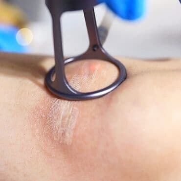 estetik: 10600 lazer cilalanması vasitəsilə müxtəlif kosmetoloji və estetik — 3