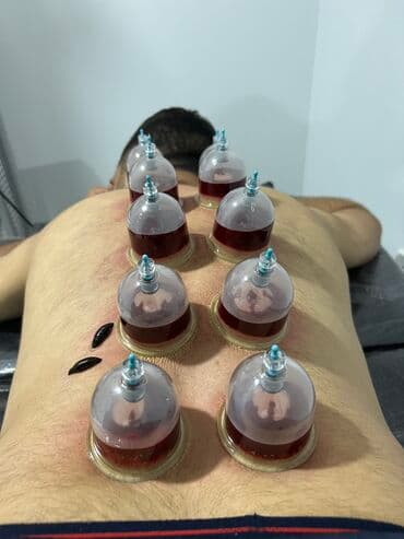 ağ dırnaq modelleri: Hicamanın Faydaları✅ *Qan dövranın pozulması *Qanın təmizlənməsi — 15