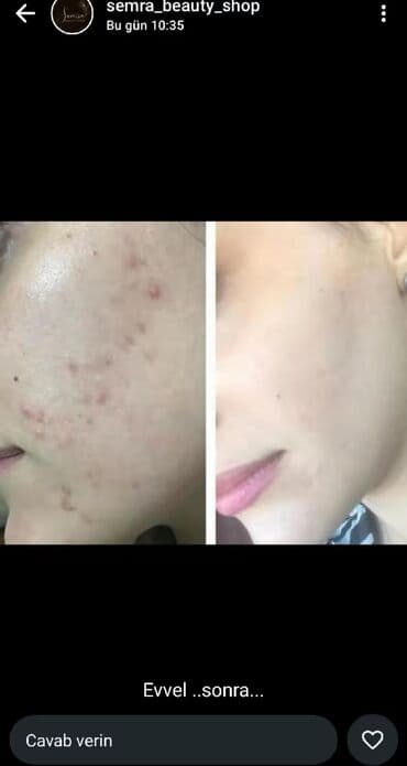 таблетки для похудения в баку: Saç üçün yağ, Saç tökülməsinə qarşı — 16