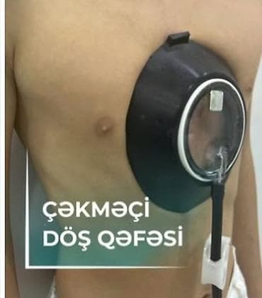 инвалидное кресло в аренду: Sinə batıxlığı üçün vakum. Uşaqlarda Vakumlu döş qəfəsi retraktoru — 1