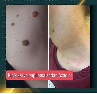 Обучение, курсы: Xal, ziyil və papillomaların yandırılması xidməti - Bədəndə və üzdə — 1