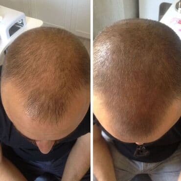 Sac similasyonu, tokulmus ve yanmis saclarin berpasi — 2