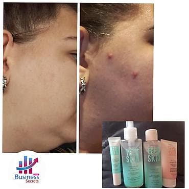 TEEN SKIN dəriyə qulluq seti Məhsul tərkibi: - Gel yuma vasitəsi (üz lalafo.az -da TEEN SKIN dəriyə qulluq seti Məhsul tərkibi: - Gel yuma vasitəsi (üz