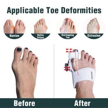 Əlil arabaları: Podaqra üçün fiksator Qiymət : 28 AZN ( tək ) ✔️El arasında podaqra — 3