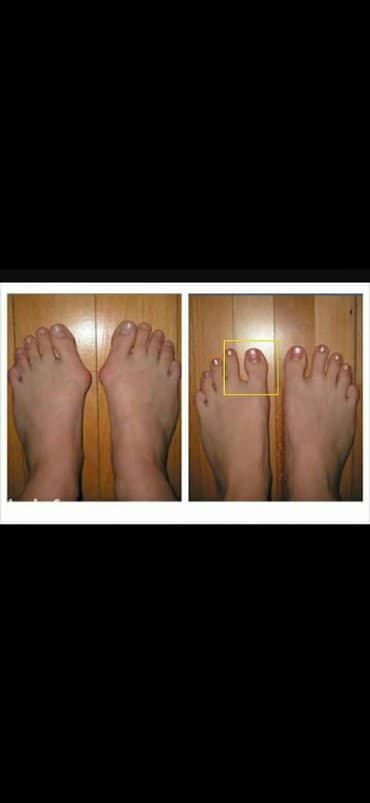 Tibbi avadanlıq: Bu mualice eden ve agrinin qarşisini alan fiksator. Silikon oldugu — 3