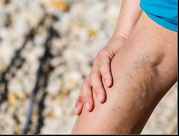 gozelik salonu: Varikoz müalicəsi, Evə gəlməklə, Klinikada — 1