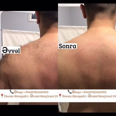 sari tukler ucun lazer: Kişilər üçün Lazer Epilasiya✅ Üz,Boyun,Boğaz,Qulaq,Burun = 10 AZN — 3