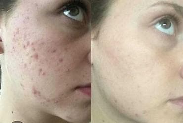 infert macun terkibi: Üz geli, Yağlı dəri üçün — 4