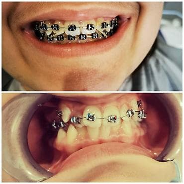 акция на установку брекетов: İnstaqram dr.zerif). Seçilən pasientlerə sonda kappa hədiyyə — 4