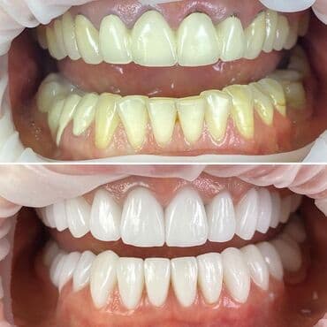 акция на установку брекетов: Stomatoloji xidmetler tam steril ve muasir. dislerin plomblanmasi — 2