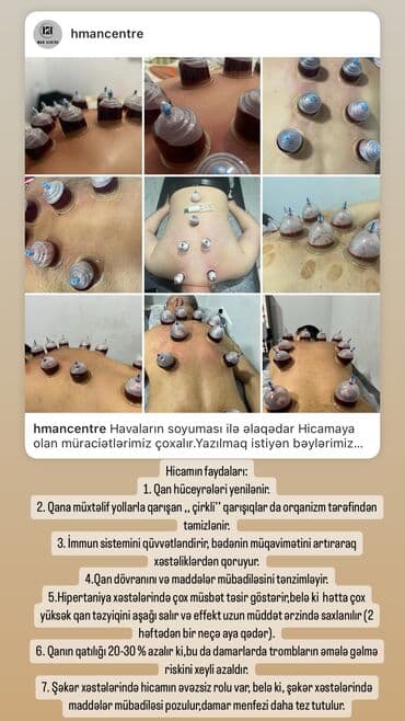 ağ dırnaq modelleri: Hicamanın Faydaları✅ *Qan dövranın pozulması *Qanın təmizlənməsi — 17