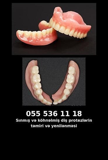 Xidmət: Sınmış və köhnəlmiş diş protezlərinin təmiri və yenilənməsi