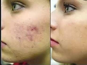 infert macun terkibi: Üz geli, Yağlı dəri üçün — 1