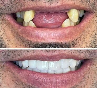 акция на установку брекетов: Stomatoloji xidmetler tam steril ve muasir. dislerin plomblanmasi — 4