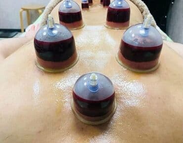 zeli: Xicama (qanın vakuumla çıxarılması) xidməti - Klassik və nöqtəvi — 3