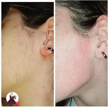 telebelere iş: Lazer Epilyasiya Xidməti – Candela Alexandrite ilə - Peşəkar lazer — 5