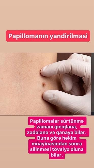 Xidmət: Papillomaların yandırılması (aradan qaldırılması) Təsvir: -