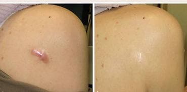 gözelik salonu: Yara izi korreksiyası xidməti - Fraksional mikroiynə və aparat — 2