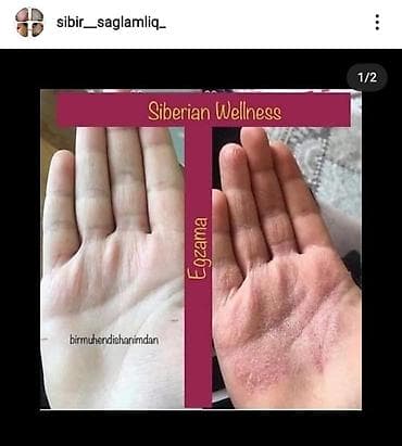 gumus sepler: Deri xestelikleri.sac tokulmesi.kecellesme.kepek.ayaqda qribok.iy — 2