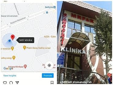 акция на установку брекетов: İnstaqram dr.zerif). Seçilən pasientlerə sonda kappa hədiyyə — 7